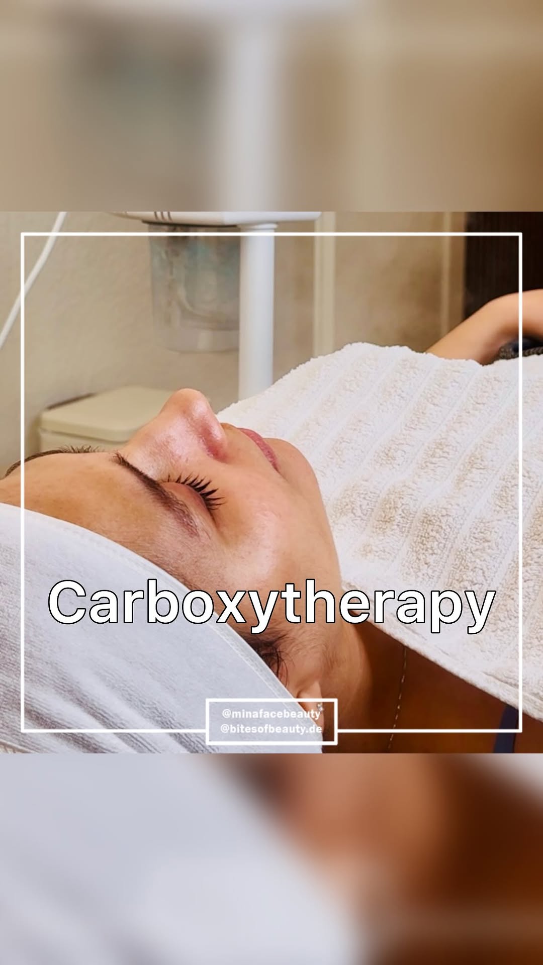 Carboxytherapie Vorher Nachher bei Bites of Beauty