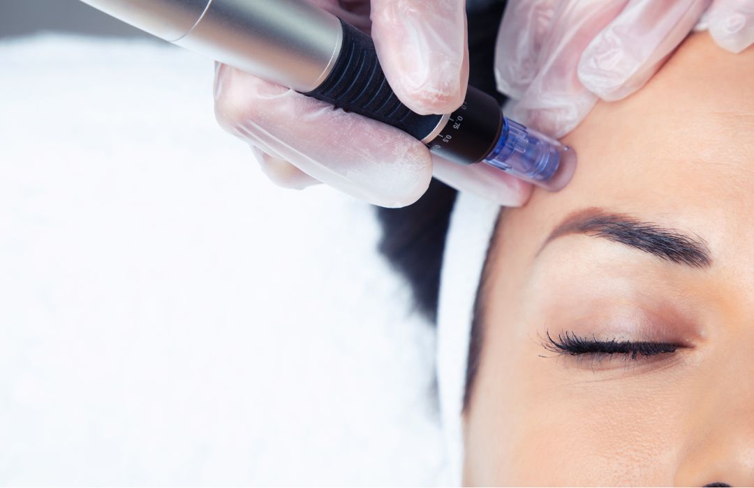 Microneedling